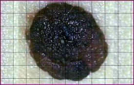 Skin Cancer Image Search